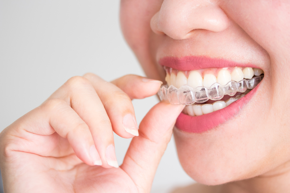 clear aligners