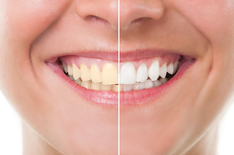 Teeth Whitening in Moscow